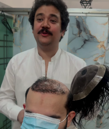 Hair Patch 1 1