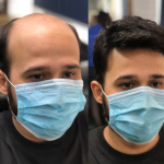 Hair Patch Before After 1
