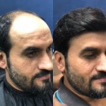 Hair Patch Before After 2