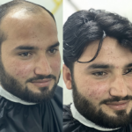 Hair Patch Before After 3