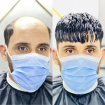 Hair Patch Before After 4